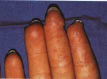 imagen dedo afectado