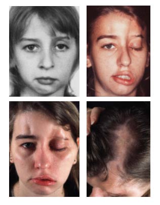 imagen rostro afectado